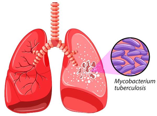 tuberculosis